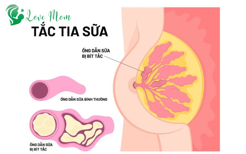 Dấu Hiệu của Tắc Tia Sữa