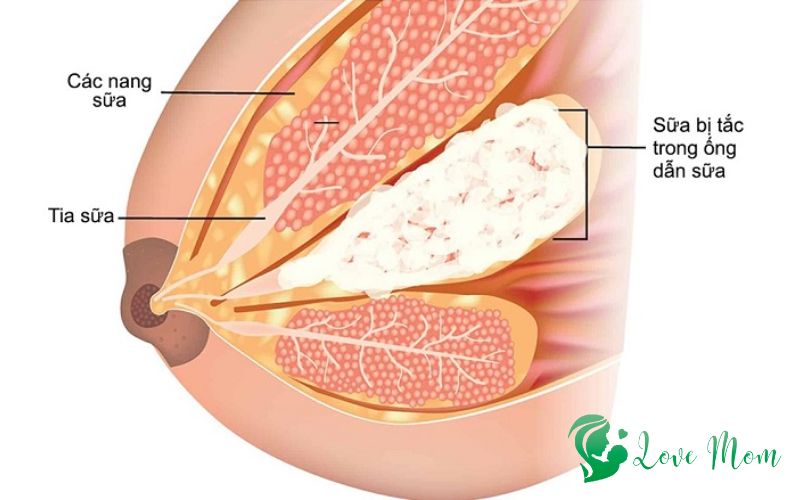 Một số biểu hiện của tắc tia sữa sau sinh