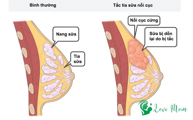 Tia-sua-binh-thuong-va-tia-sua-noi-cuc