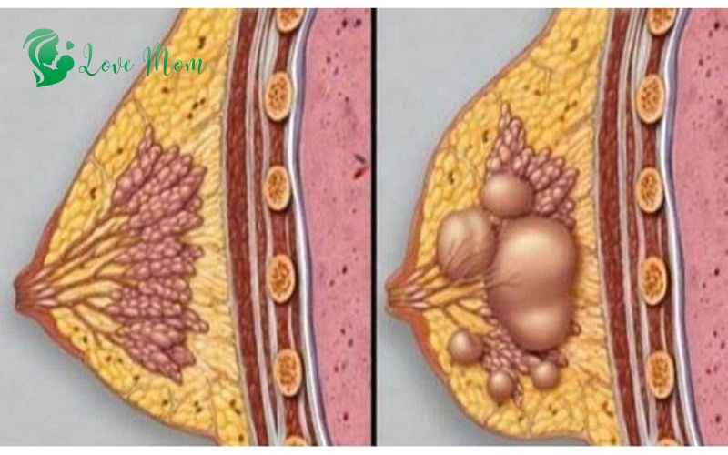 Hình ảnh áp xe vú sau sinh